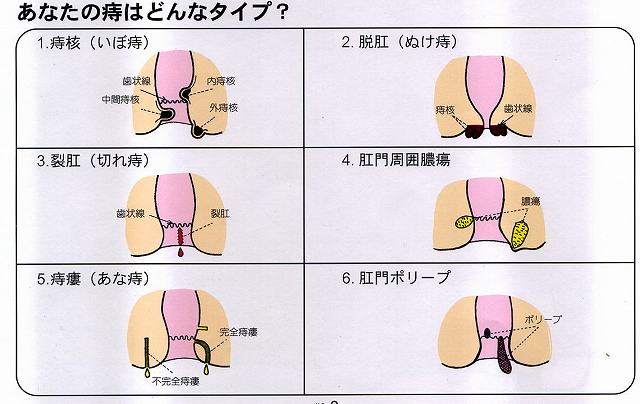 痔の種類