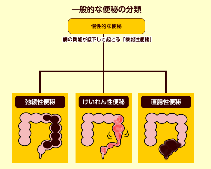 タイプ別便秘解消法まとめ 女性の7割が苦しむ機能性便秘の改善法