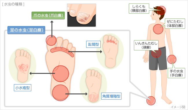 水虫の種類