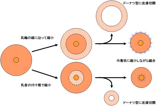 乳輪の縮小手術